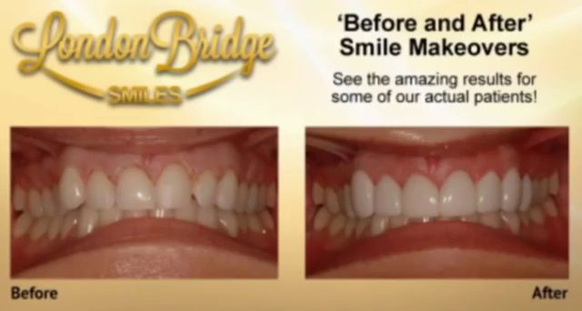 London Bridge Smiles